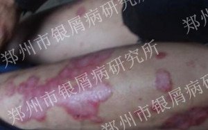 身上出红斑还很痒是银屑病吗?