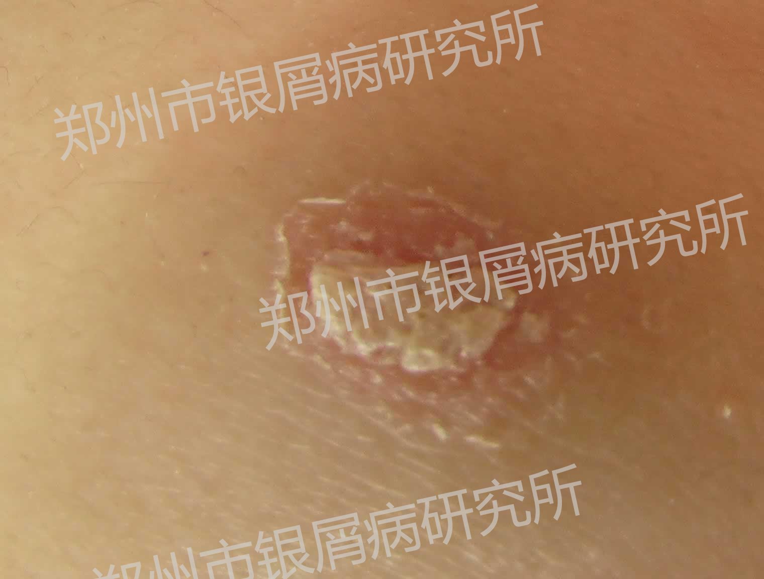 银屑病有哪些危害?
